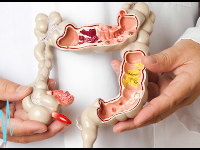 la colostomia es una discapacidad