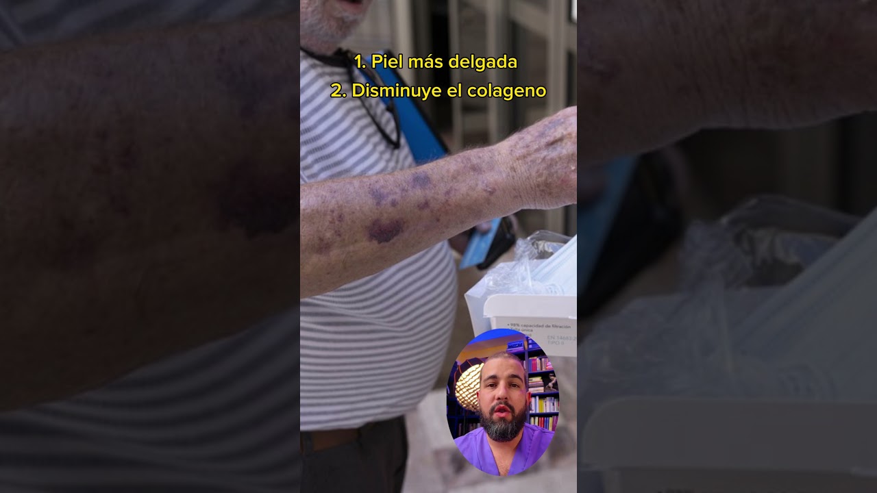 manchas de sangre en la piel de los ancianos