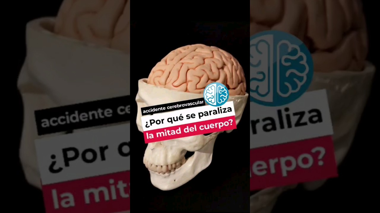 paralisis medio cuerpo por estres