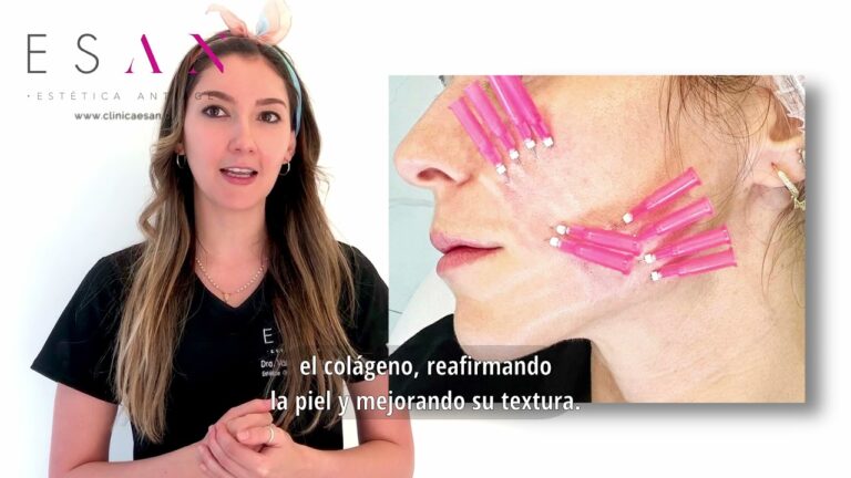 que son los hilos tensores