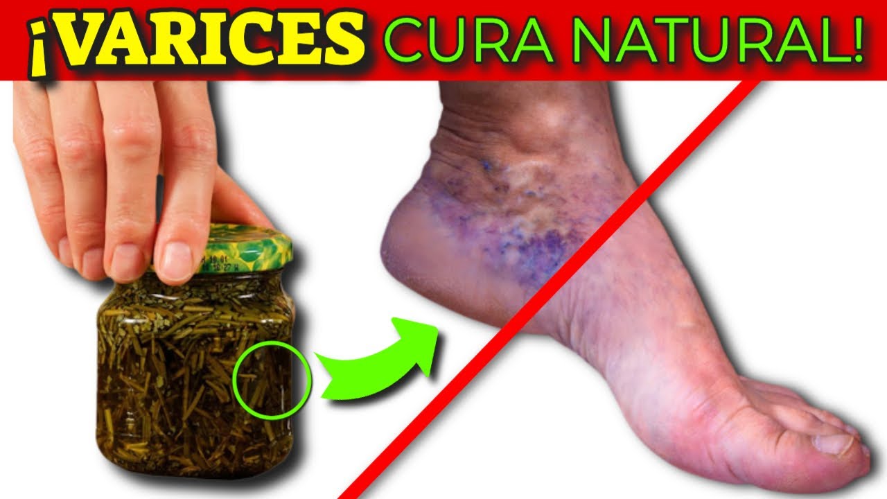 venas inflamadas en los pies